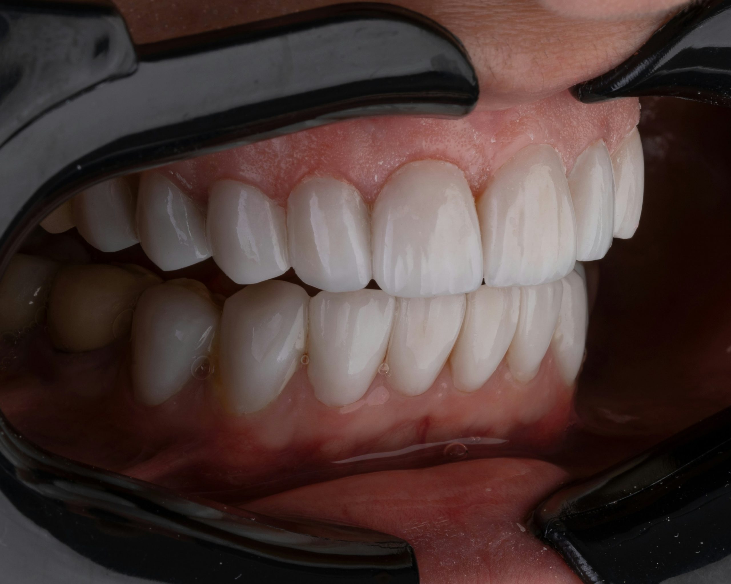 ClearCorrect vs. Invisalign: Which Clear Aligner Wins the Smile Game?